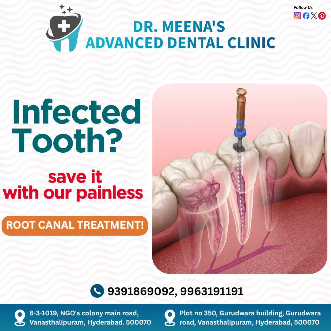 root-canal-treatment-vanasthalipuram