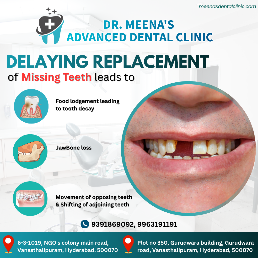 dental-implants-in-vanasthalipuram